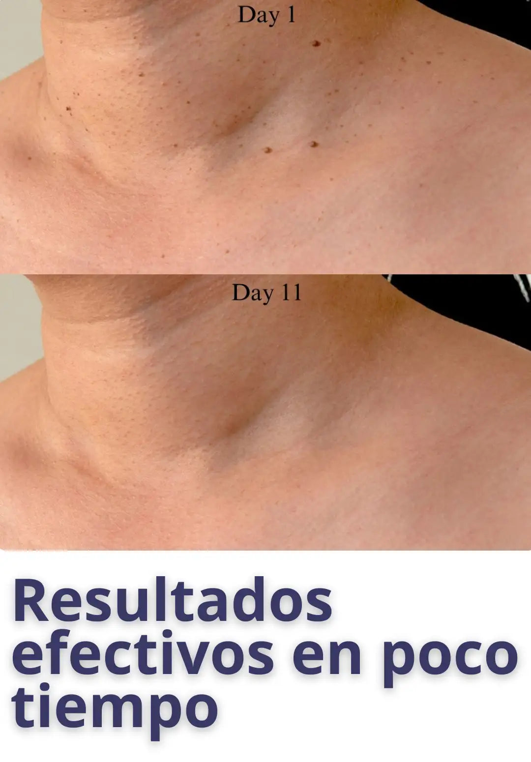 Kit TagBuddy® ¡No más verrugas! hoy 🎁40%DCTO🎁